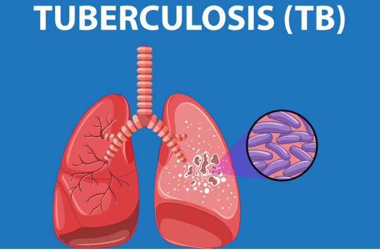 Tuberculosis Diagnosis & Treatment
